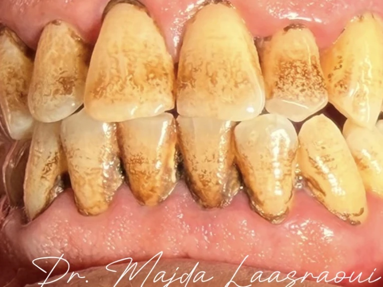 Avant : tartre et colorations sur l’ensemble des dents