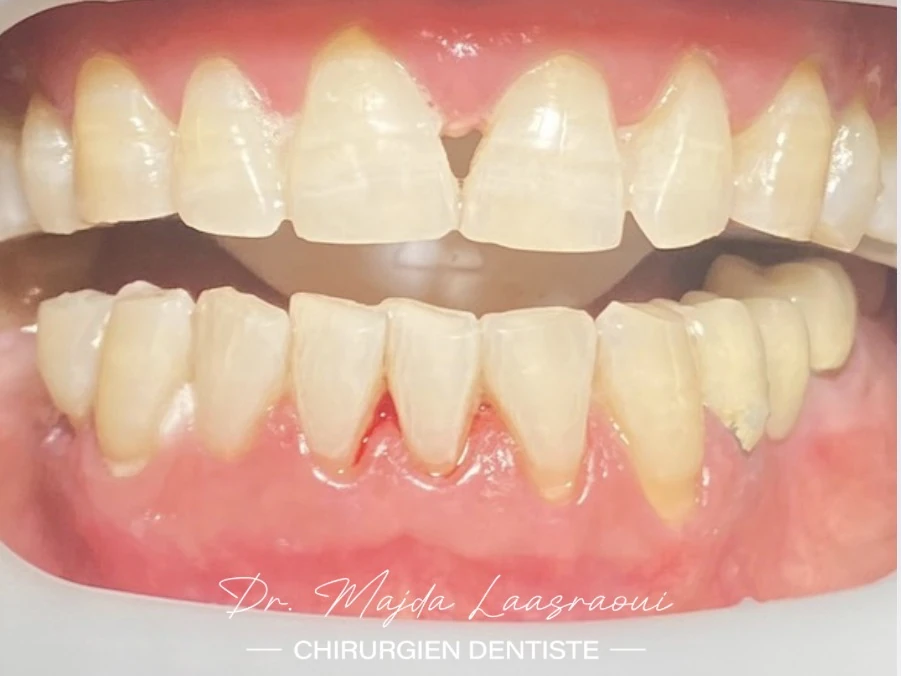Après : dents éclaircies après blanchiment